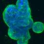 Scientists identify molecule driving one of the deadliest forms of breast cancer