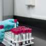 New blood test for tuberculosis could reduce the spread of this top global infectious-disease killer